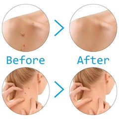 Skin Tag Remover Kit | Skin Care Rubber Bands for Face Mole and Wart Removal detail view