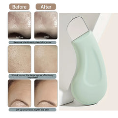 Facial Blackhead Removal Tool | Nose Deep Cleansing Skincare Tool detail view
