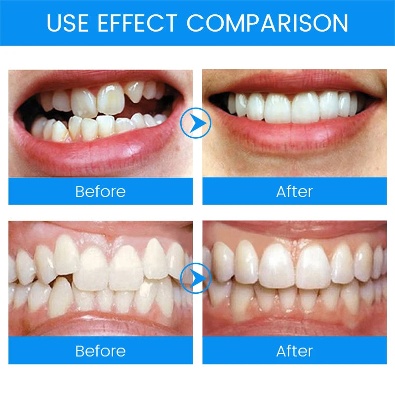 3 Stages Dental Orthodontic Teeth Retainer | Anti-Snoring & Teeth Straightening Mou additional angle