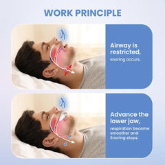 Anti Snoring Mouth Guard | Dental Night Guard for Bruxism and Sleep Aid detail view