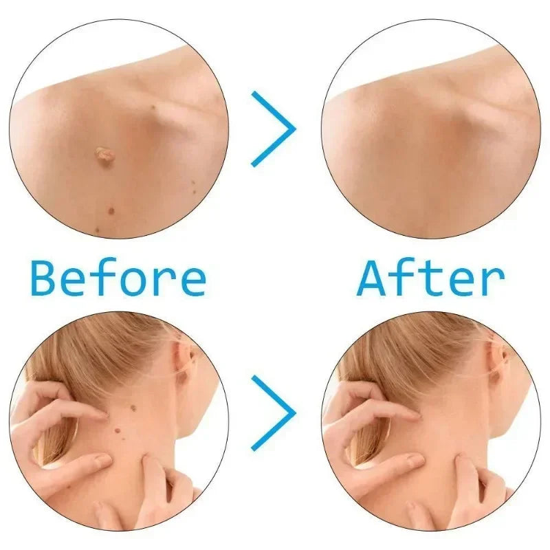 Skin Tag Remover Kit | Skin Care Rubber Bands for Face Mole and Wart Removal detail view