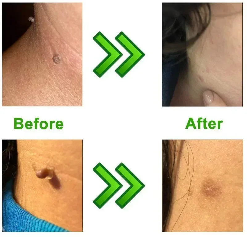 Skin Tag Remover Kit | Skin Care Rubber Bands for Face Mole and Wart Removal lifestyle view