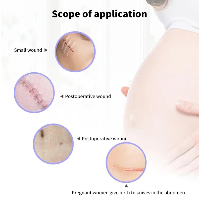 5 Strips Wound Skin Closure Strips | Medical Suture Free Surgical Tape additional angle