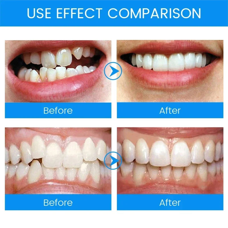 3 Stages Dental Orthodontic Braces Teeth Retainer | Anti Snoring Mouth Guard for Br additional angle