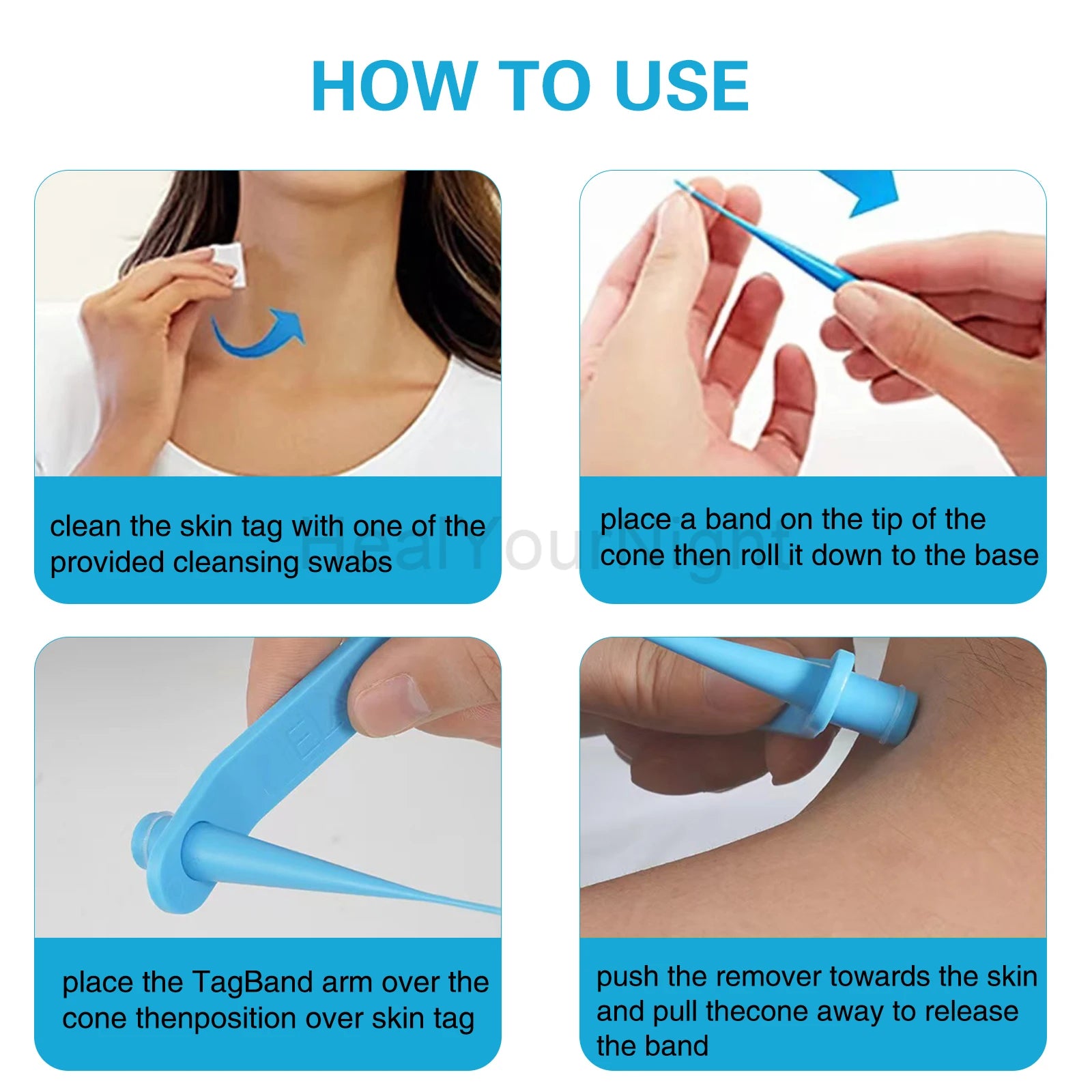 3-IN-1 Painless Skin Tag Removal Kit | Skin Label, Mole, Acne & Wart Removal Pen Set wit detail view