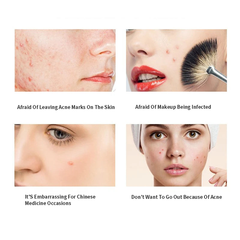 Acne Pimple Patch Invisible Waterproof | Hydrocolloid Spot Treatment for Blemishes close-up view