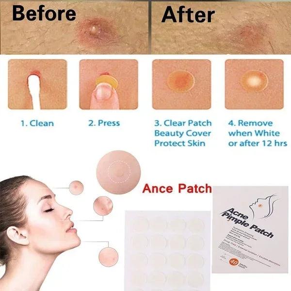 24 Pcs Hydrocolloid Acne Patches | Pimple Spot Treatment Stickers for Face detail view