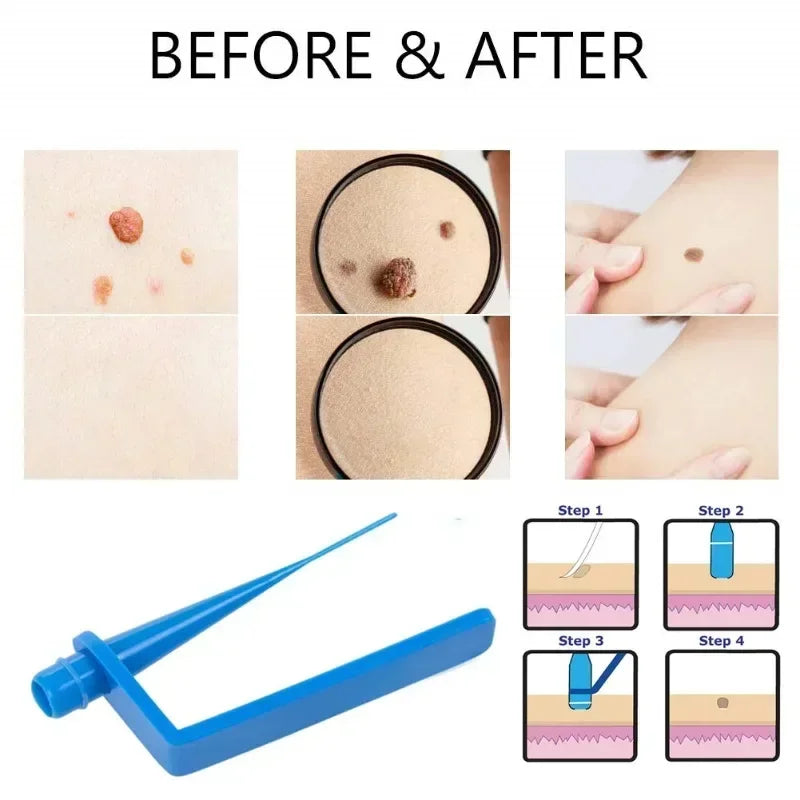 Skin Tag Remover Kit | Skin Care Rubber Bands for Face Mole and Wart Removal close-up view