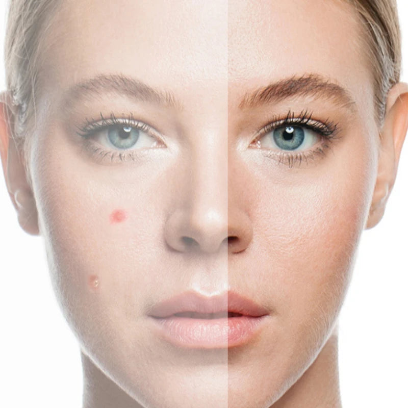 Invisible Acne Patches | Hydrocolloid Pimple Spot Stickers for Clearer Skin lifestyle view