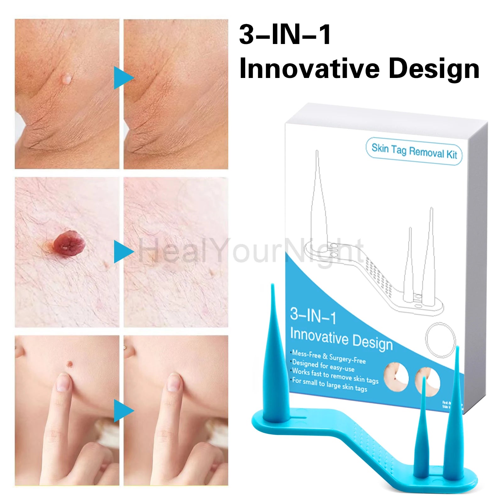 3-IN-1 Painless Skin Tag Removal Kit | Skin Label, Mole, Acne & Wart Removal Pen Set w close-up view