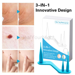 3-IN-1 Painless Skin Tag Removal Kit | Skin Label, Mole, Acne & Wart Removal Pen Set w close-up view