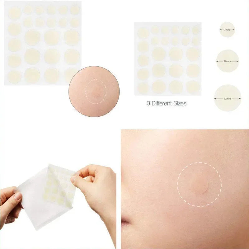 24 Pcs Hydrocolloid Acne Patches | Pimple Spot Treatment Stickers for Face alternate view