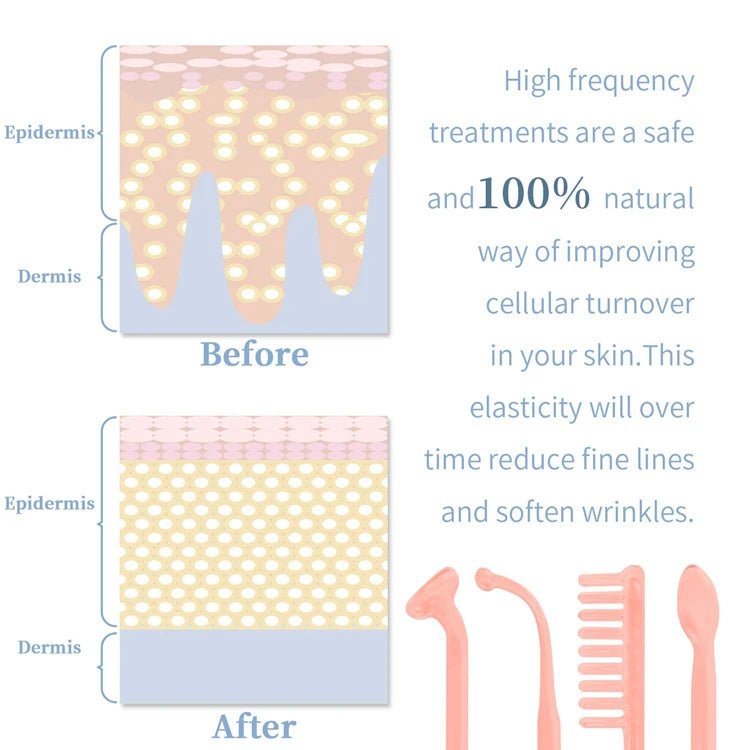 High Frequency Skin Therapy Wand – Portable Handheld Device - Onlytenbucks.com