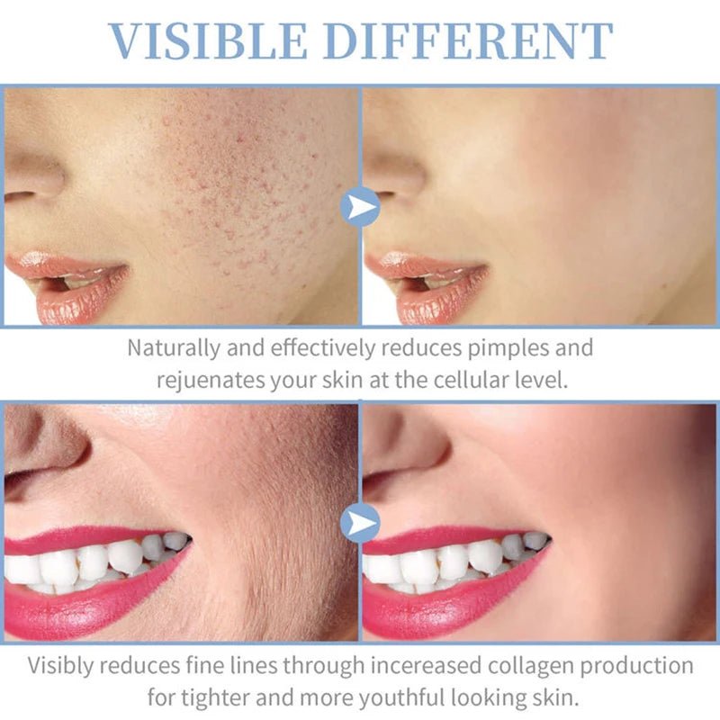 High Frequency Skin Therapy Wand – Portable Handheld Device - Onlytenbucks.com